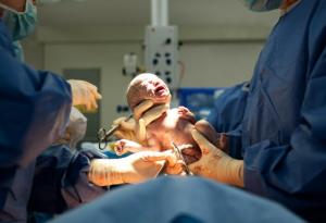 Нов метод за секцио имитира естествено раждане