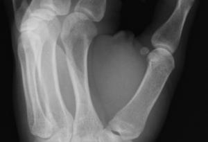 Рентгеновите лъчи са открити съвсем случайно