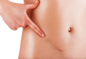 Ново лепило може да сложи край на белезите