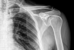 В СССР са презаписвали забранени плочи върху рентгенови снимки