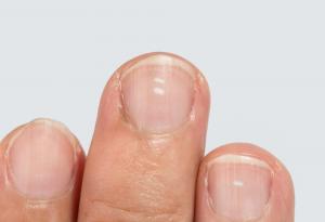 Какви са тези бели линии по ноктите ми?