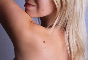 Самонаблюдението на бенките е важно, за да се предпазим от рак на кожата