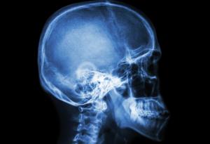 Нова медицинска технология принтира черепи по поръчка