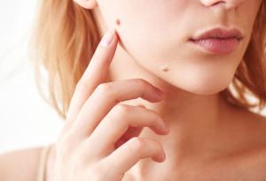 Науката обяснява: трябва ли наистина да се притеснявате за тези бенки?