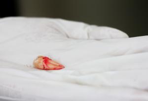 Мъж, оплакващ се 20 години от запушен нос, се оказва със зъб в ноздрата си