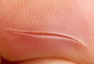 Учени откриха как да накарат раните да зарастват без белези