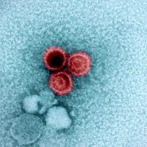 Свързаха лупуса с вирус, който над 95 процента от нас носят – и вече знаем защо