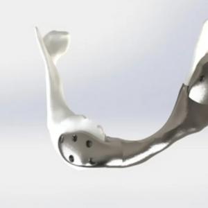 Пациент с рак получи първата в света 3D принтирана титанова челюстна кост
