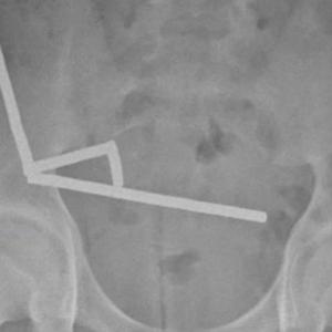 Тийнейджър загуби част от червата си, след като погълна близо 200 магнита