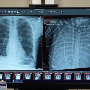 Пациент оцеля 48 часа без бели дробове в подготовка за трансплантация