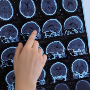 Създадоха тест за ранна диагностика на множествена склероза