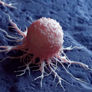 Повечето предотвратими случаи на рак са свързани само с два навика