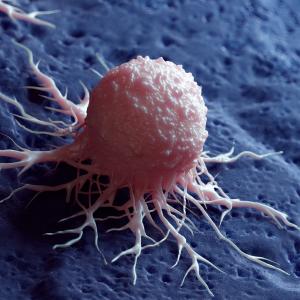 Повечето предотвратими случаи на рак са свързани само с два навика