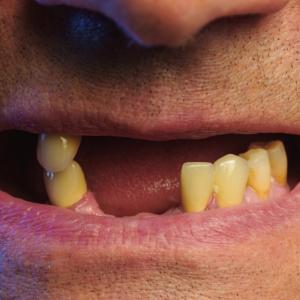 Клиничните изпитвания на терапия за възстановяване на зъби стартират догодина