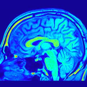 Промените във формата на мозъка могат да бъдат свързани с риск от деменция