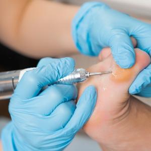 Мазолите - кога вече не са безопасни?