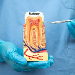 Учени създадоха гел, който възстановява зъбния емайл и може да сложи край на кариеса