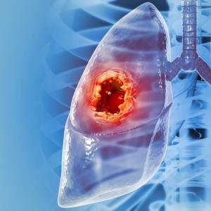 Липсващ раков ген обяснява защо някои тумори на белия дроб реагират добре на имунотерапия