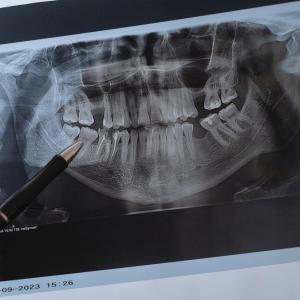 21-годишно проучване свързва пародонтозата и кариесите с повишен риск от инсулт