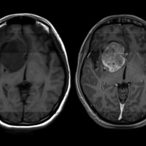 За този смъртоносен рак на мозъка няма лек. Учени обаче откриха как да го преборят
