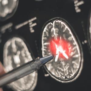 Виаграта може да се окаже едно от най-добрите налични средства за лечение на Алцхаймер