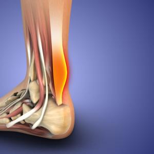 Болка в сухожилията: кои са най-честите причини и как да я облекчим?