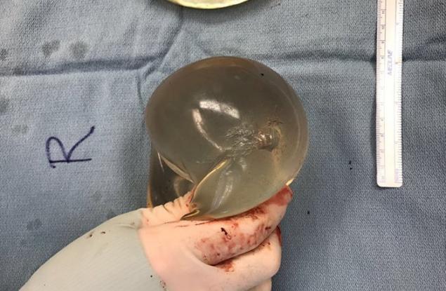 Гръден имплант спаси живота на жена, като промени траекторията на куршум