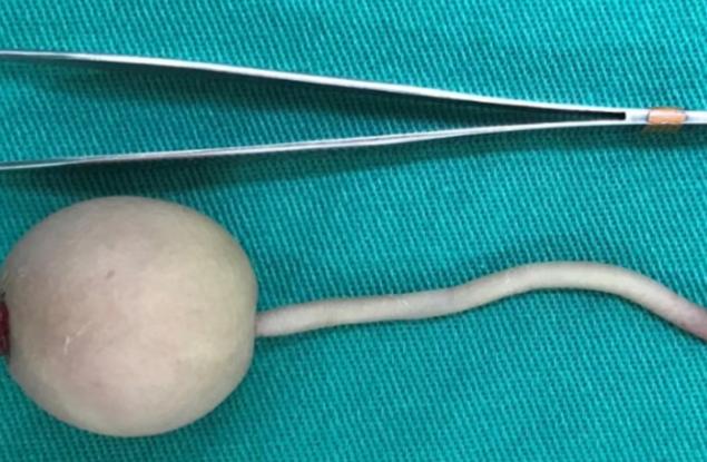 Роди се бебе с 12-сантиметрова „човешка опашка“ в Бразилия