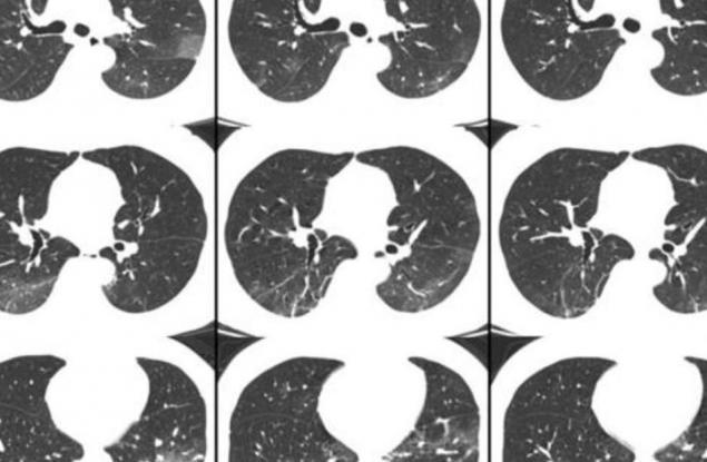 Ето какво се случва с белите дробове на хора с COVID-19