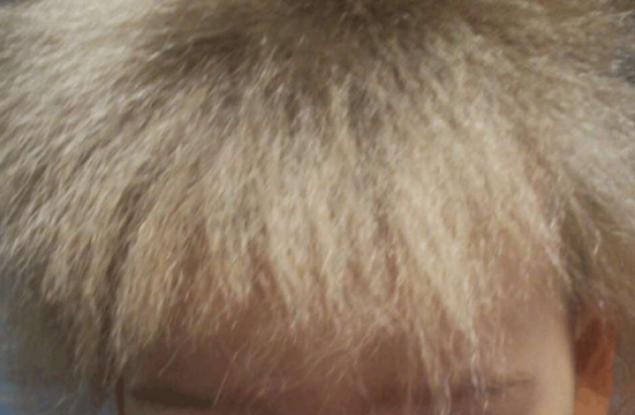 Момче е сред 100-те души в света, страдащи от „синдрома на непокорната коса“