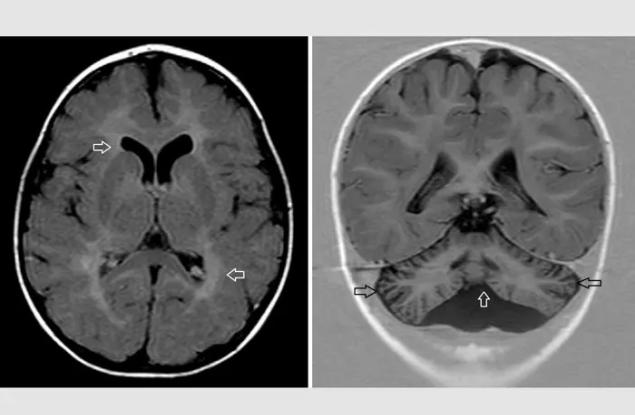 Изследователи разгадаха медицинската загадка на неврологични симптоми при деца