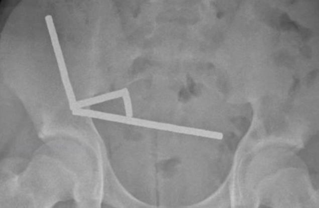 Тийнейджър загуби част от червата си, след като погълна близо 200 магнита