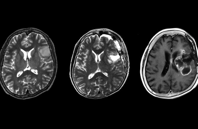 Пациентите с рядък вид астроцитом - тумор на неврона - имат по-лоша прогноза от очакваното