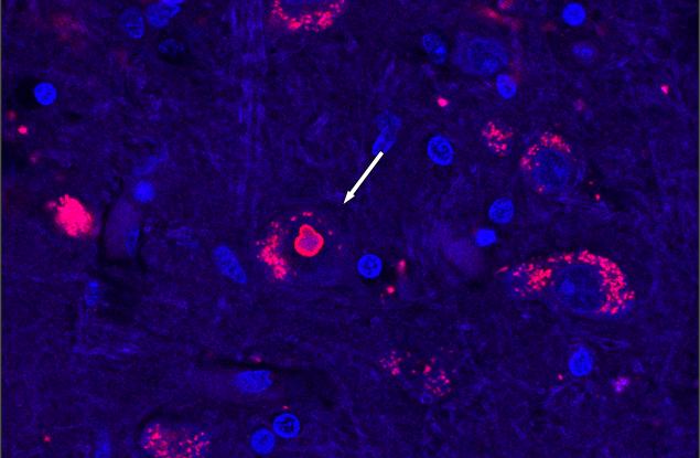 Генетичната причина за рядко неврологично заболяване е открита след 25-годишно търсене