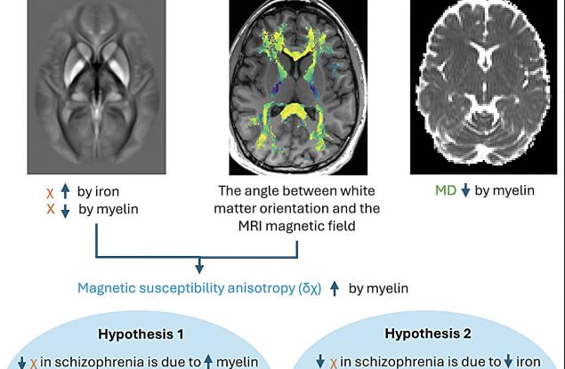 Шизофренията е свързана с дефицит на желязо и миелин в мозъка