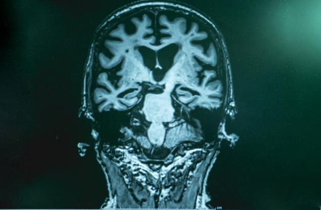 Изкуствен интелект може да диагностицира деменция за един ден – години преди първите симптоми