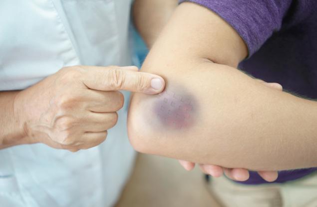 Защо на жените по-често излизат синини 