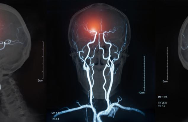 Ето какво се случва по време на инсулт
