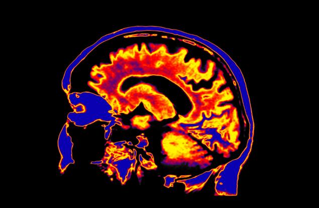 Изследване установи поразителни промени в нивата на металите в мозъка на болни от Хънтингтън 