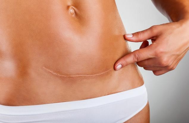 7 неща, които ми се ще да знаех за възстановяването от секцио