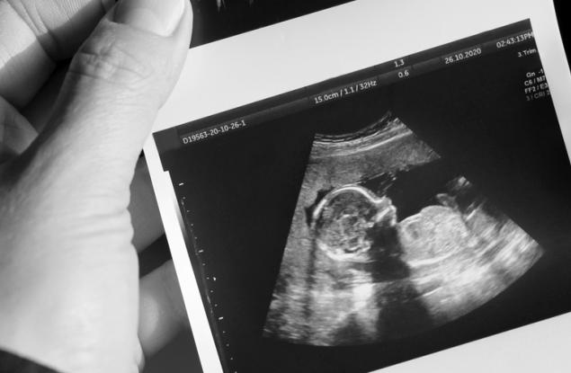 Шанс 1 на 50 милиона: Жена с двойна матка забременя и във всяка има по едно бебенце