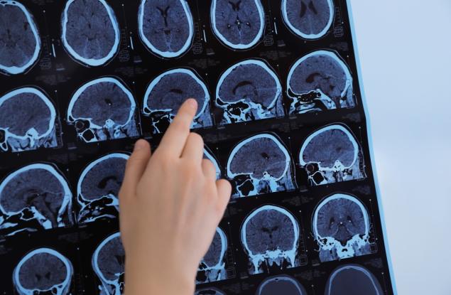 Създадоха тест за ранна диагностика на множествена склероза