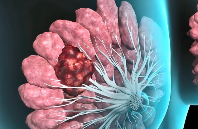 Проучване разкрива защо имунотерапиите не действат при най-трудно лечимите видове рак на гърдата