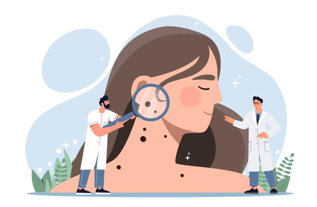 Кога са опасни бенките?