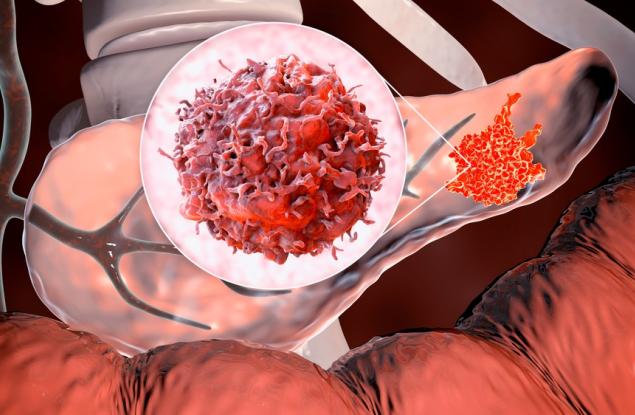 Нов дихателен тест може да промени из основи ранното откриване на рак на панкреаса