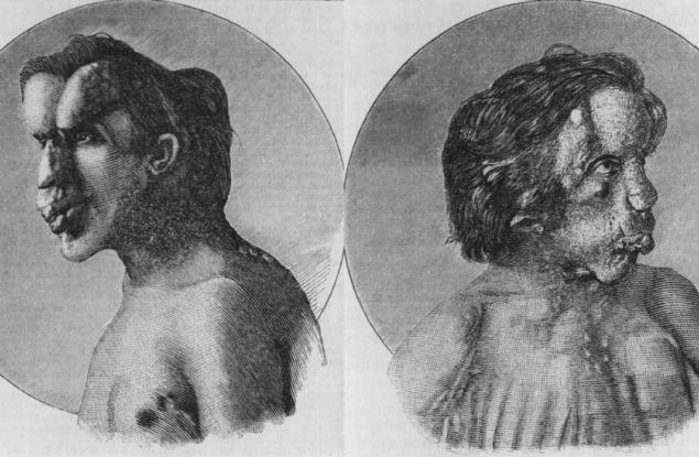 Изненадващата, тъжна и истинска история на „Човека слон“