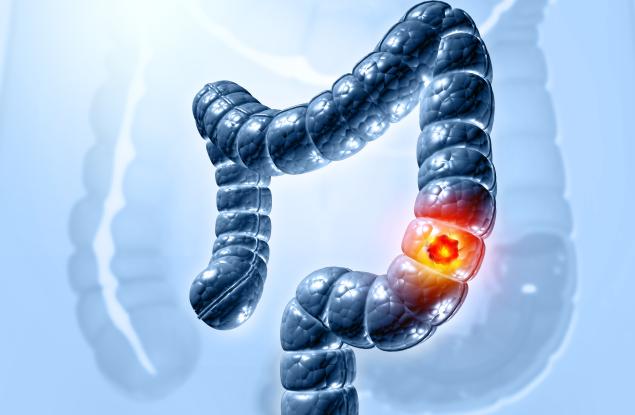 Новооткрит вирус в чревните бактерии е свързан с колоректалния рак