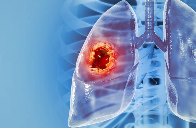 Липсващ раков ген обяснява защо някои тумори на белия дроб реагират добре на имунотерапия