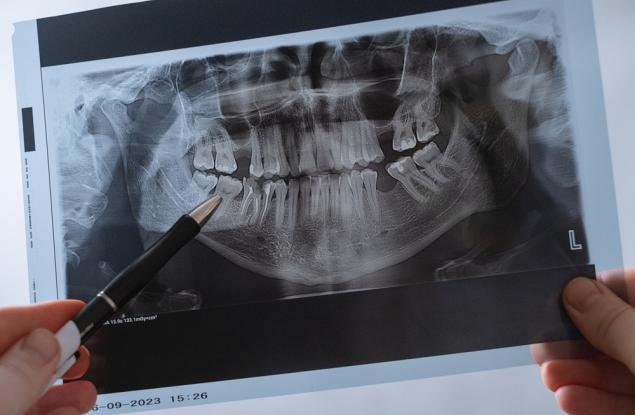 21-годишно проучване свързва пародонтозата и кариесите с повишен риск от инсулт