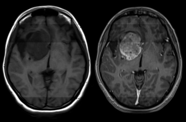 За този смъртоносен рак на мозъка няма лек. Учени обаче откриха как да го преборят